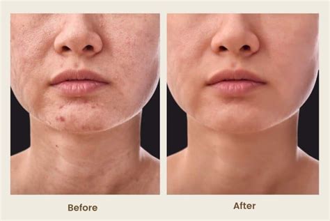 Exosome Facial Rejuvenation Newport Beach CA | PCH MedSpa