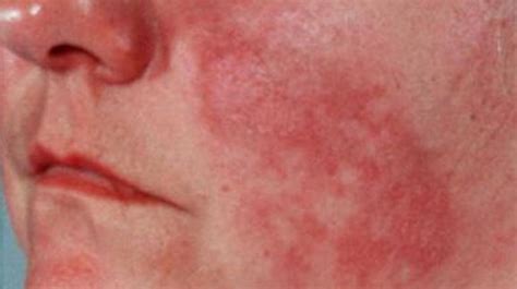 24+ Get Rid Of Lupus Rash can even be} part {of the ]