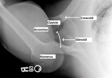 Identify the pathology on this axillary view of the shoulder. | little white coats