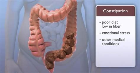 My Family Medicine Practice: Chronic Constipation - Causes , Signs&Symptoms And Management