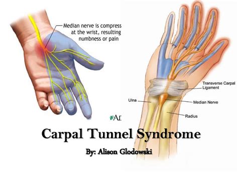 Carpal Tunnel Syndrome - Symptoms and Treatment