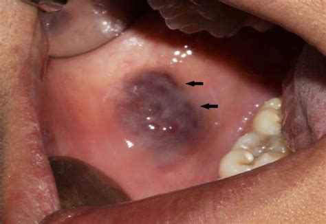 Intra oral view showing bluish purple lesion on right buccal mucosa... | Download Scientific Diagram