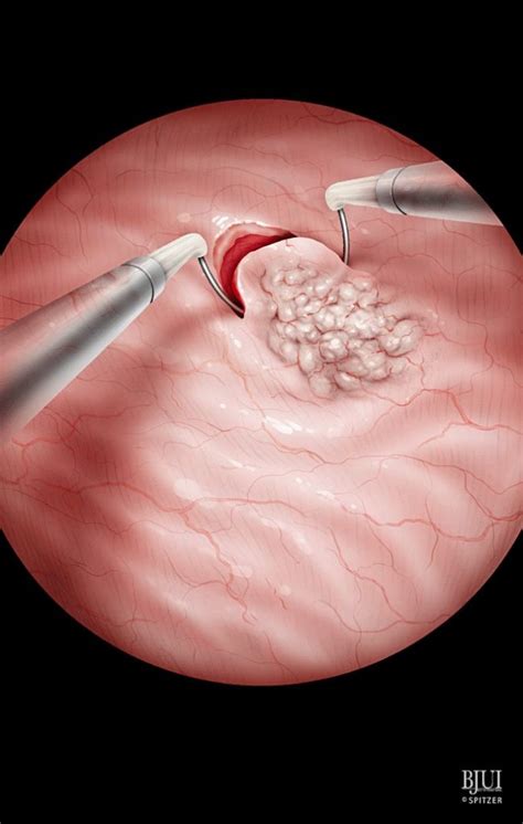 Transurethral Resection of Bladder Tumour Sydney | TURBT Procedure