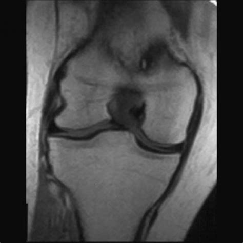 Ganglion cyst of the anterior cruciate ligament detected by MRI | Eurorad