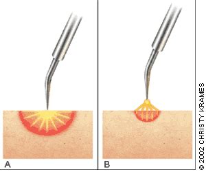 Electrosurgery for the Skin | AAFP