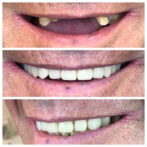 Denture Before & After Transformations — All Smiles Denture Clinic