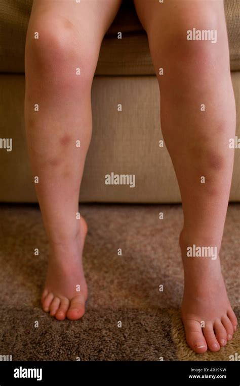 Bruises on the legs hi-res stock photography and images - Alamy