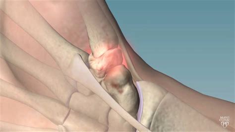 Thumb Arthritis - Carolina Regional Orthopedics