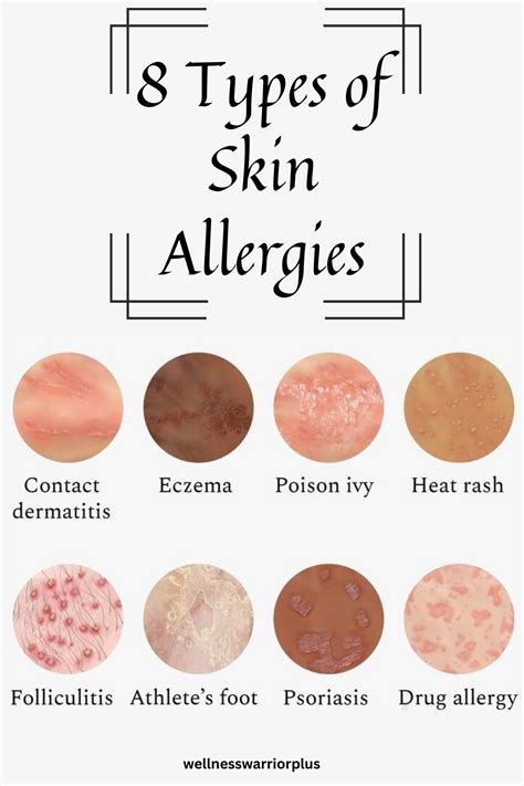 8 Types of Skin Allergies | Skin allergies, Allergies, Health tips