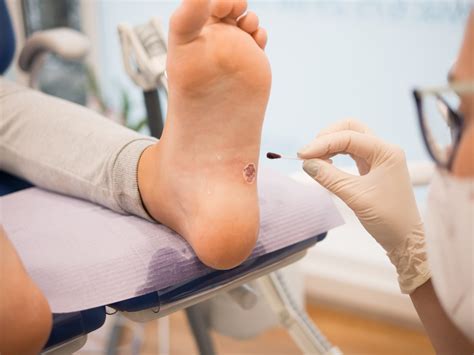 Warts on Your Feet? Symptoms & Causes of Plantar Warts - Foot and Ankle Group