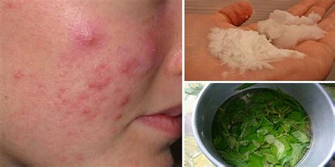 7 Cystic Acne Home Remedies that Really Work - The Stylish Life