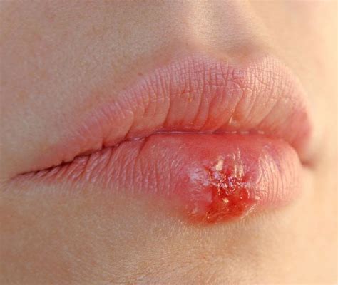 Treating swollen lips at home: all cases from allergy to bites and traumas