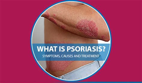 Psoriasis : Symptoms, Causes and Treatment - VPS Lakeshore