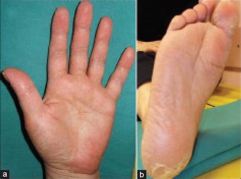 PALMOPLANTAR ERYTHRODYSESTHESIA AS A DIAGNOSTIC SIGN IN COVID-19