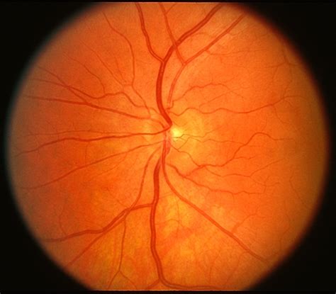 Normal Fundus Photo - Retina Image Bank