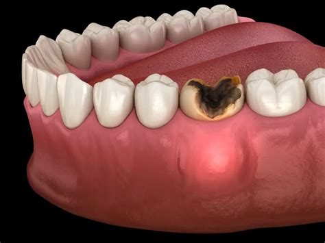 Abscess Tooth Face Swelling