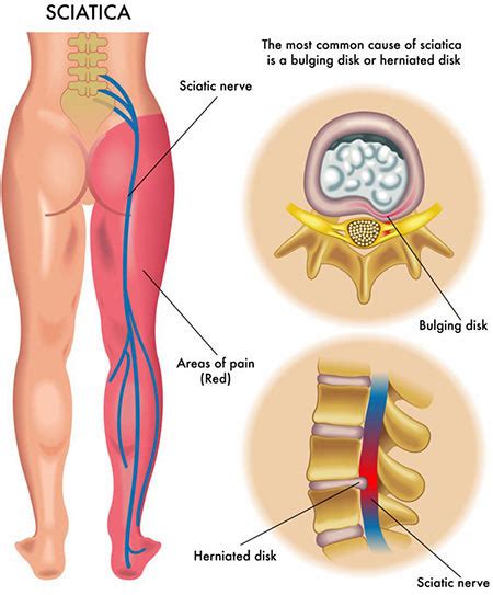 Lower Back Pain Treatment NYC | Lower Back Pain Doctors Specialists