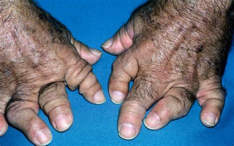 Diagnostic symptoms of psoriatic arthritis | MIMS online