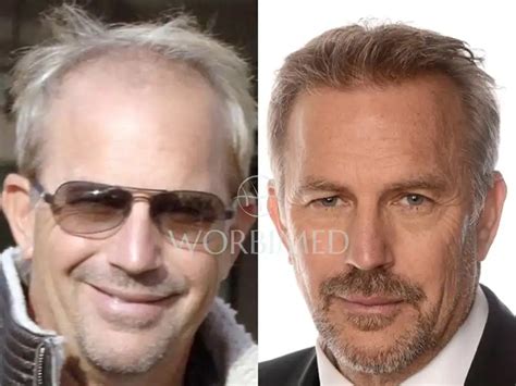 Kevin Costner Hair Transplant l Before and After