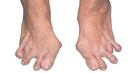 Rheumatoid Arthritis Feet Early Signs