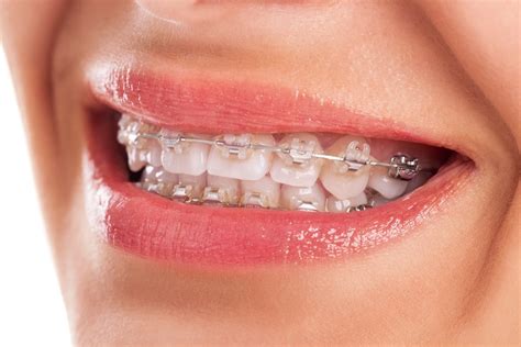 Orthodontics: What are ligatures and why are they used? - Dental Negligence Team