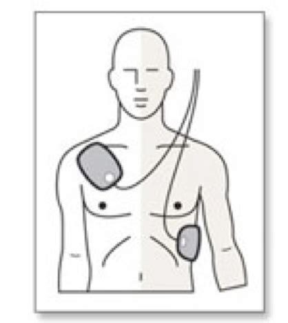 Public Access Defibrillators - What are they and how to use one - Orchard Training