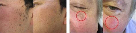 Benign Skin Growths: Causes, Treatment & Prevention - Toronto Dermatology Centre