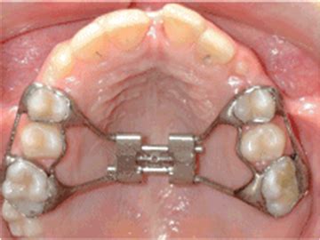 Difference in Pain Perception Between Banded and Bonded Hyrax during Rapid Palatal Expansion