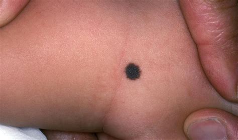 Common Birthmarks - The Clinical Advisor