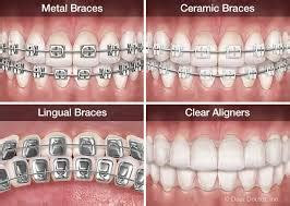 History and Types of Braces - Best Orthodontist NYC