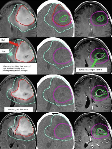 Glioma | Radiology Key