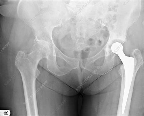 Hip joint replacement (image 2 of 2) - Stock Image - C002/9626 - Science Photo Library