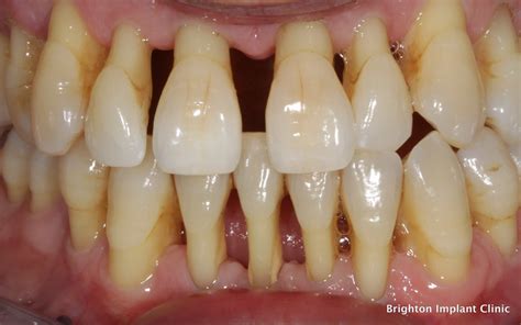 What Causes Periodontal or Gum Disease?