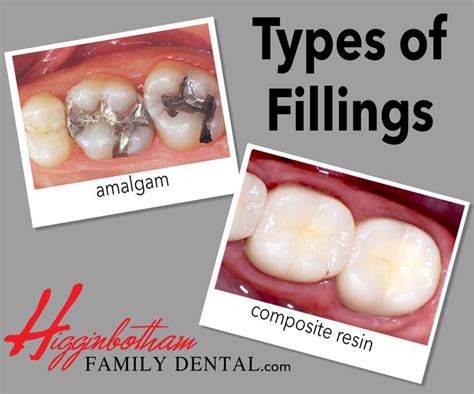 Composite Resin Fillings | Dental fillings, Tooth colored fillings, Filling