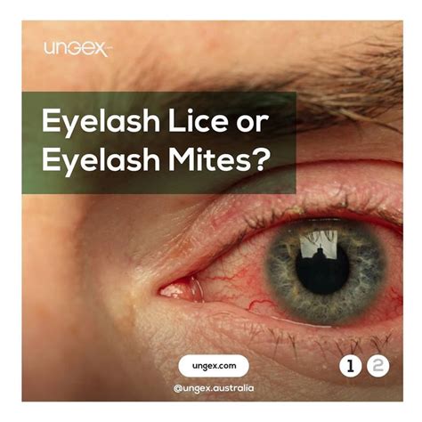 What Are Eyelash Lice? | Eyelashes, Eyelash mites, Demodex mites