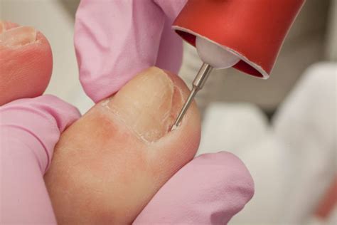 Ingrown Toenails Surgery and Pain Treatment in Boca Raton, FL