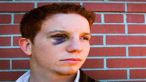 Black Eye: Causes, Symptoms, Diagnosis & Treatment - Boldsky.com