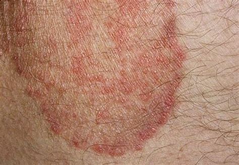 Skin rashes that itch all over body - retyperfect
