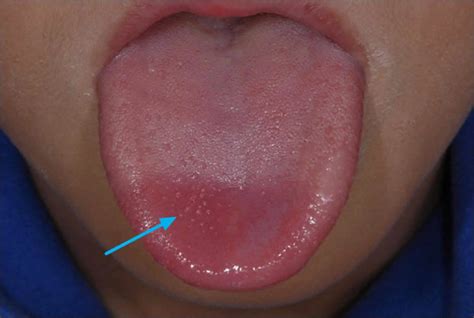 White Bump On Tongue Cancer