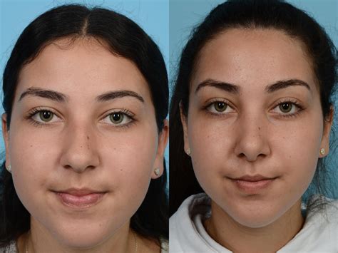 Rhinoplasty Before & After Photos Patient 586 | Chicago, IL | TLKM Plastic Surgery