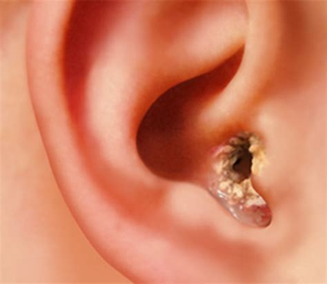 Dry Eczema In Ears at Tasha Wiebe blog