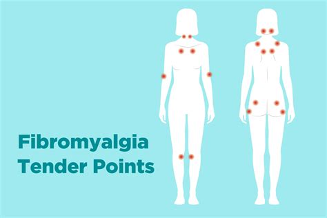 Fibromyalgia Tender Points: What and Where Are They?