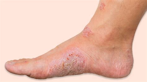 Diabetic Foot Ulcers Symptoms Causes Types Diagnosis Treatment – NBKomputer