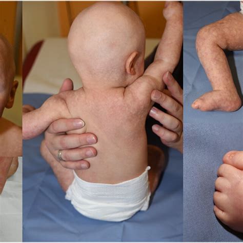 Patient aged 14 months with Rothmund–Thomson syndrome type 1 and ...