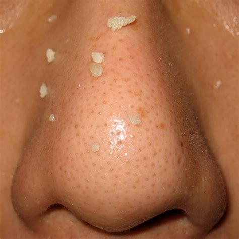 White bumps in cat's mouth ulcers, how to get rid of pimples and blackheads on your nose ...
