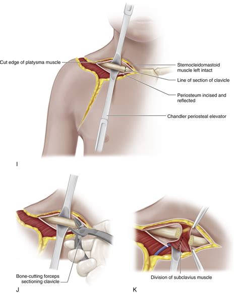 67 Posterior Approach for Forequarter Amputation (Littlewood Technique) | Musculoskeletal Key