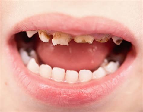 Rotten Teeth In Children Stock Photos, Pictures & Royalty-Free Images ...