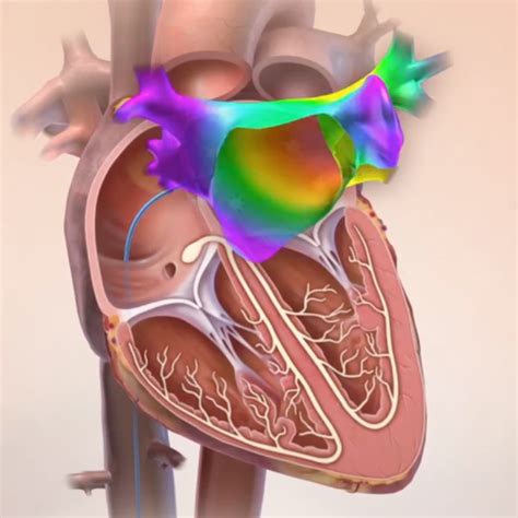 Electrophysiology Mapping