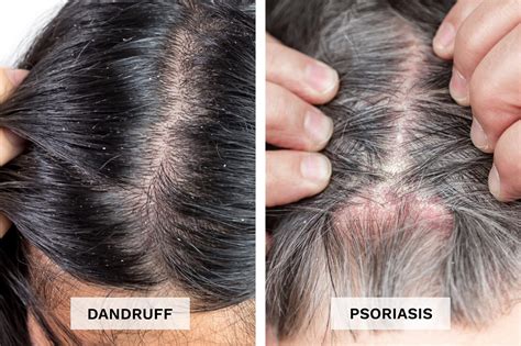 Scalp Psoriasis vs. Dandruff: What's Causing Your Flakes? | The Healthy