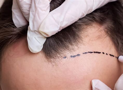 Explore the Latest Hair Transplant Techniques | CoVa Hair